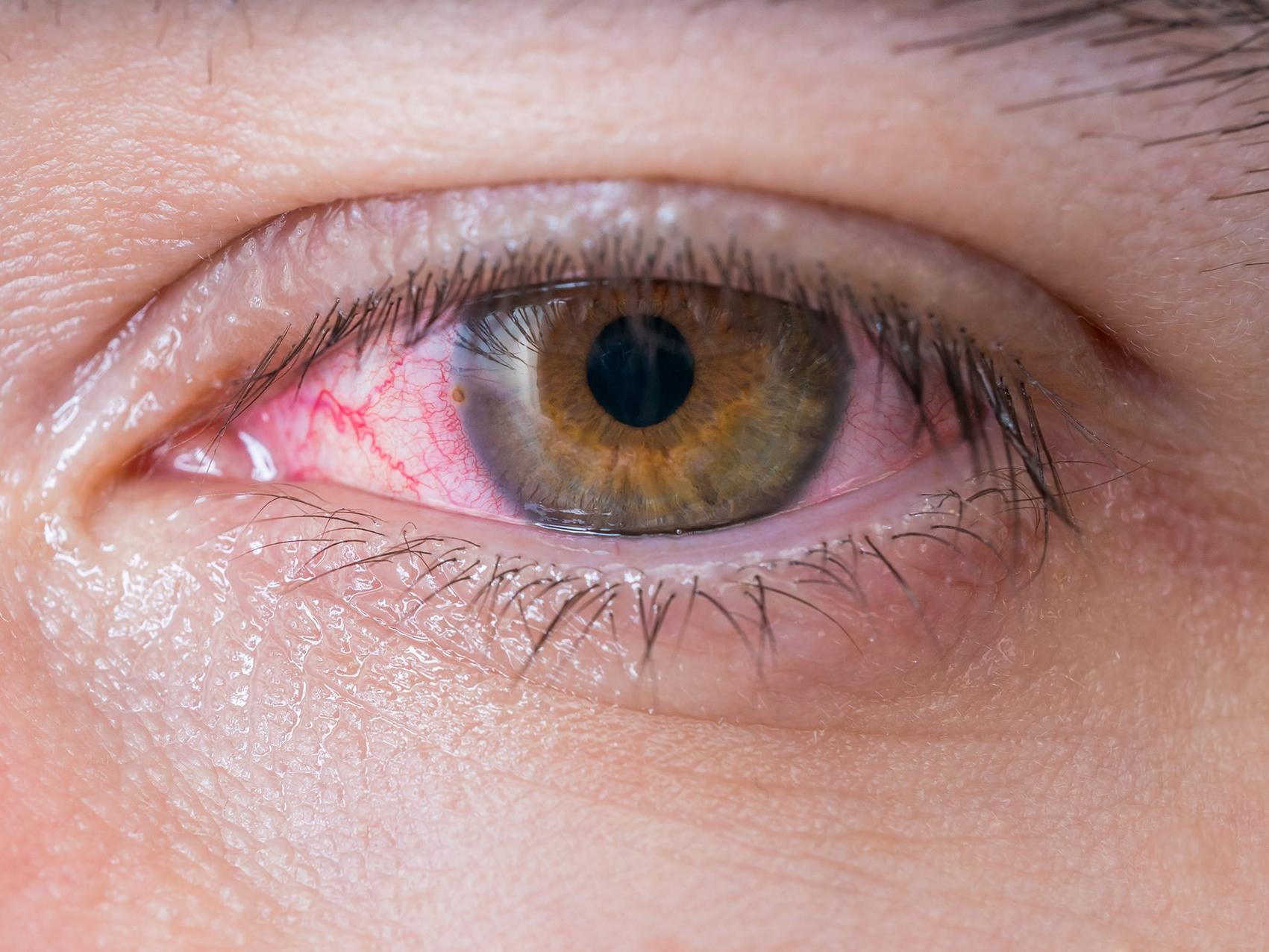 画像は、目の危険の潜在的な可能性の兆候を示す、不健康な目のクローズアップです。 